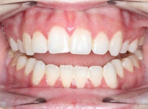 A picture of an anterior open bite ICR
