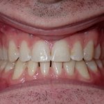 Intraoral view of healthy pink gingiva and aligned maxillary/mandibular teeth. 