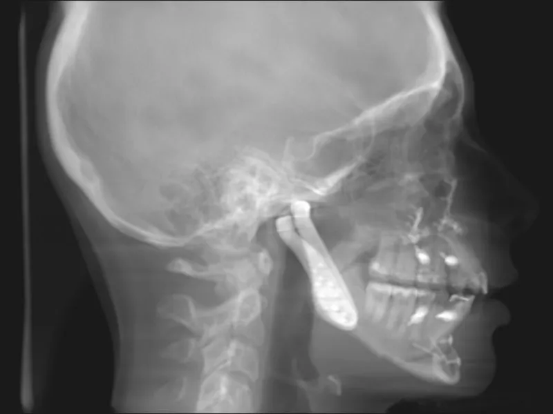 Lateral skull X-ray with tongue depressor in oropharynx, showing soft tissue and airway