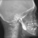 Lateral skull X-ray with tongue depressor in oropharynx, showing soft tissue and airway
