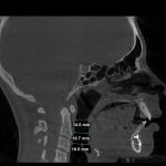 Sagittal CT scan showing airway measurements: 14.0 mm, 16.7 mm, 18.5 mm at nasal/oral cavity