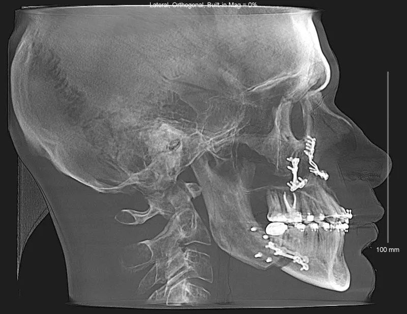 Lateral cephalometric X-ray with dental implants, cervical spine, and 100 mm scale bar