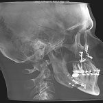 Lateral cephalometric X-ray with dental implants, cervical spine, and 100 mm scale bar