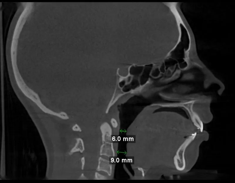 Sagittal CT scan with airway measurements: 6.0 mm and 9.0 mm at nasopharynx