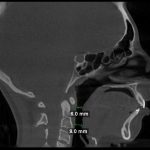 Sagittal CT scan with airway measurements: 6.0 mm and 9.0 mm at nasopharynx