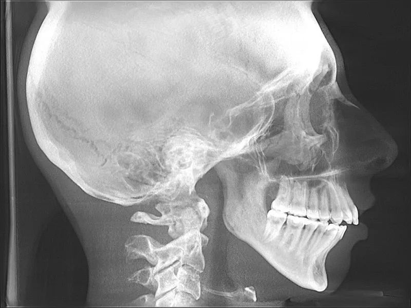 Lateral skull X-ray showing dental work, cervical spine, and intact maxillary sinus