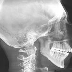 Lateral skull X-ray showing dental work, cervical spine, and intact maxillary sinus