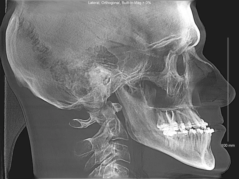 Lateral skull X-ray with dental implants, cervical spine, and visible maxillary sinus