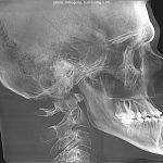 Lateral skull X-ray with dental implants, cervical spine, and visible maxillary sinus