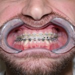 Patient with dental retractor, braces on upper/lower teeth, beard visible