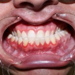 Intraoral view of healthy pink gingiva and not aligned maxillary/mandibular teeth. 