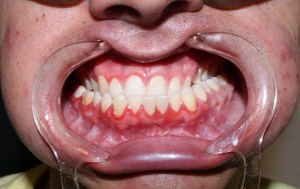 Intraoral view of healthy pink gingiva and not aligned maxillary/mandibular teeth. 