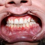 Intraoral view of healthy pink gingiva and aligned maxillary/mandibular teeth. 