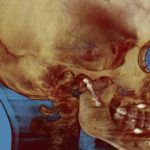 3D CT scan of skull in profile with golden-brown tones, visible teeth, blue background