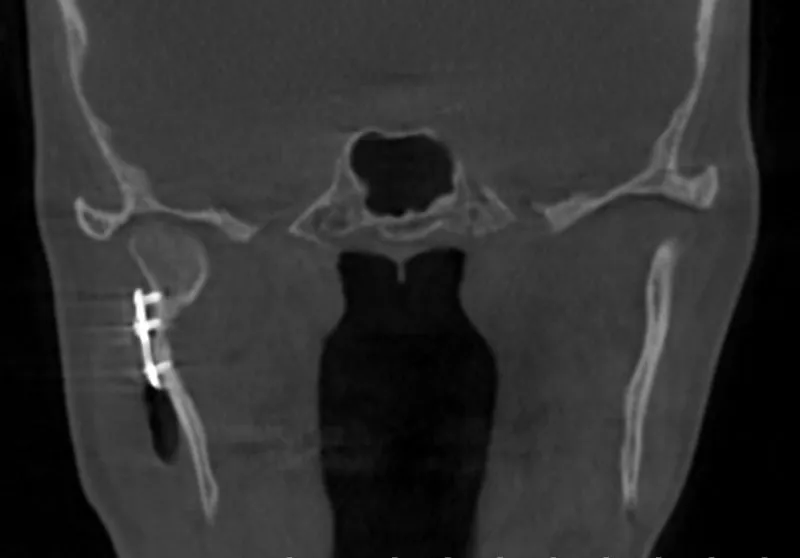 Coronal CT scan showing left mandibular dental implant, symmetric TMJ, and nasal cavity
