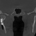 Coronal CT scan showing left mandibular dental implant, symmetric TMJ, and nasal cavity