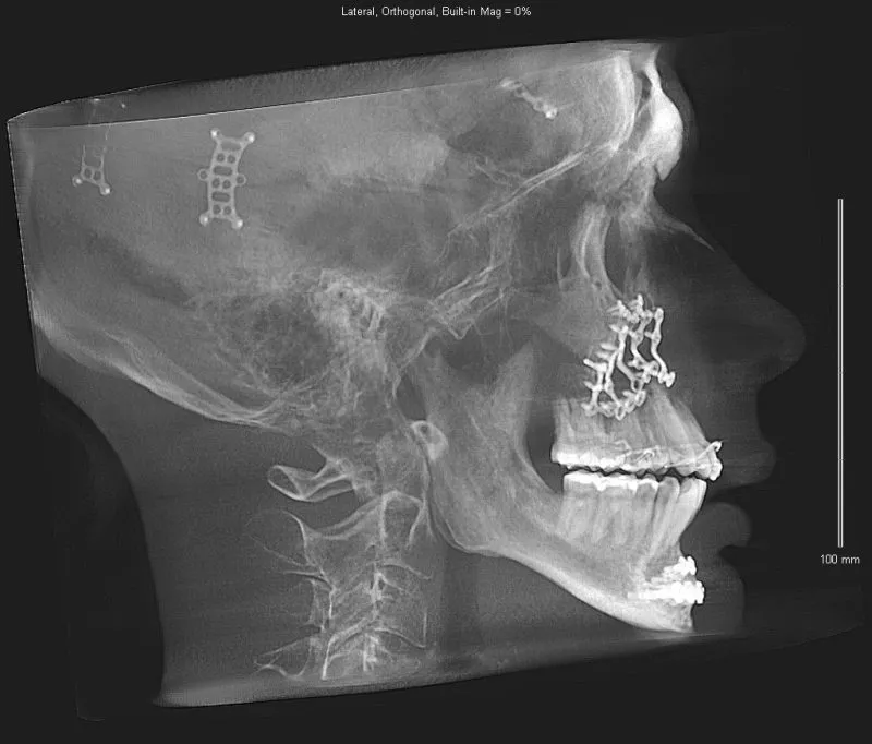Lateral X-ray of skull with surgical markers, dental structures, and cervical spine visible