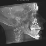 Lateral X-ray of skull with surgical markers, dental structures, and cervical spine visible
