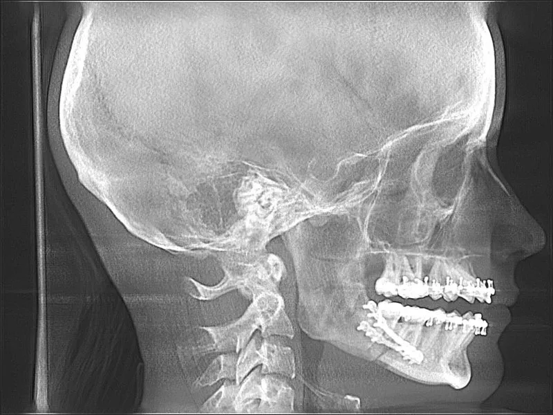 Lateral cephalometric radiograph showing dental appliances. Used for orthodontic assessment of jaw alignment. 