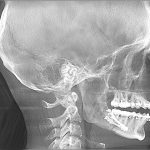 Lateral cephalometric radiograph showing dental appliances. Used for orthodontic assessment of jaw alignment. 