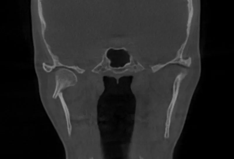 Coronal CT scan of facial bones with intact TMJ and nasal structures, no dental implant present