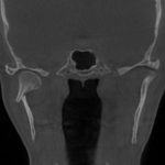 Coronal CT scan of facial bones with intact TMJ and nasal structures, no dental implant present