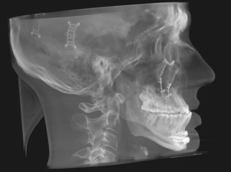 Grayscale lateral X-ray of skull with surgical markers on cranium and dental structures