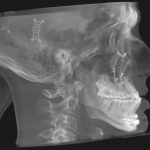 Grayscale lateral X-ray of skull with surgical markers on cranium and dental structures