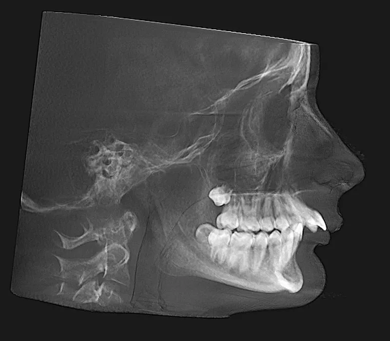 Lateral grayscale X-ray of human skull profile showing jaw, teeth, and cervical spine