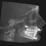 Lateral grayscale X-ray of human skull profile showing jaw, teeth, and cervical spine