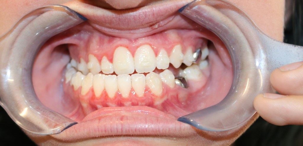 Intraoral view: dental retractor holding lips, teeth with braces