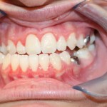 Intraoral view: dental retractor holding lips, teeth with braces