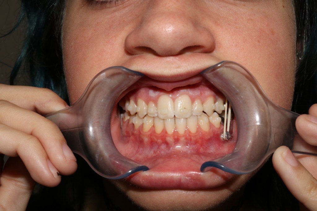 Intraoral view: dental retractor, upper/lower teeth with braces