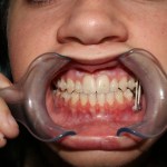 Intraoral view: dental retractor, upper/lower teeth with braces