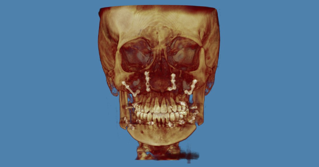 3D skull model in golden-brown tones with orthodontic wires on teeth, blue background