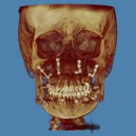 3D skull model in golden-brown tones with orthodontic wires on teeth, blue background