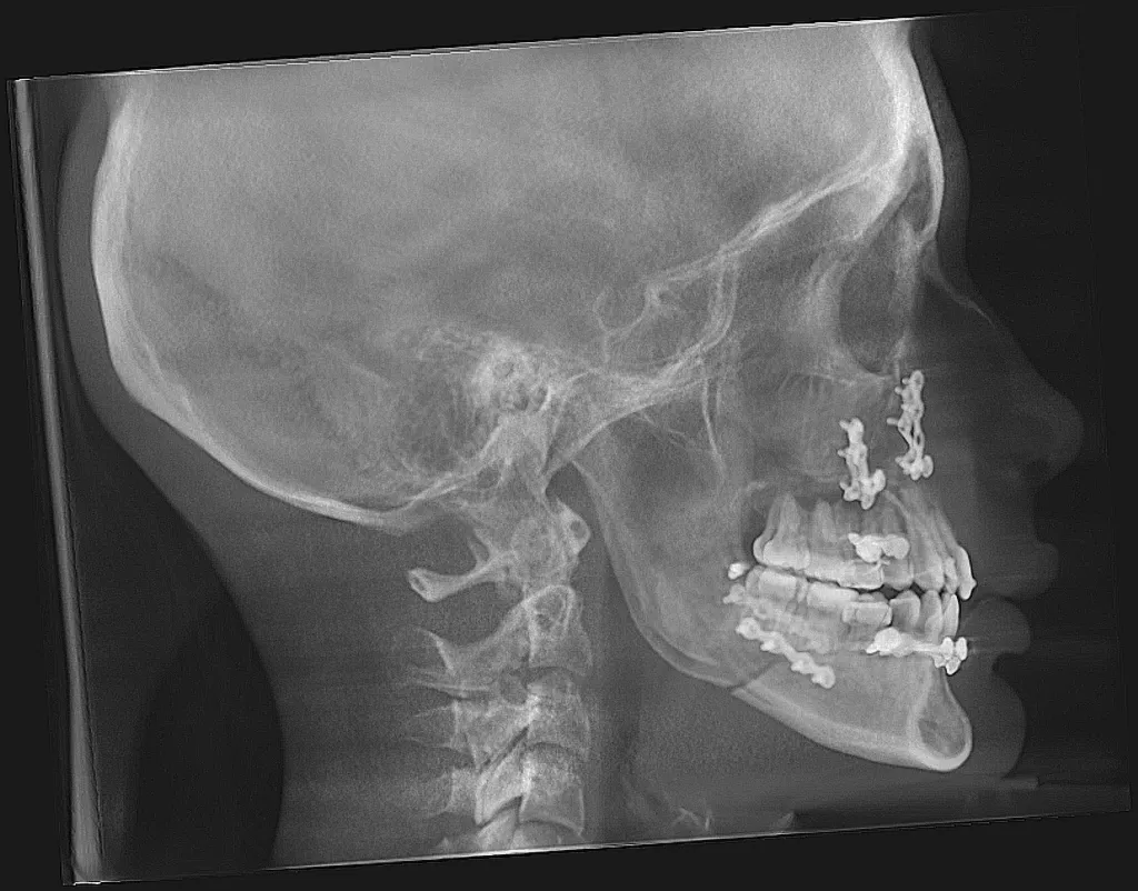 Lateral skull X-ray showing dental work, cervical spine, and intact maxillary sinus