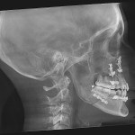 Lateral skull X-ray showing dental work, cervical spine, and intact maxillary sinus