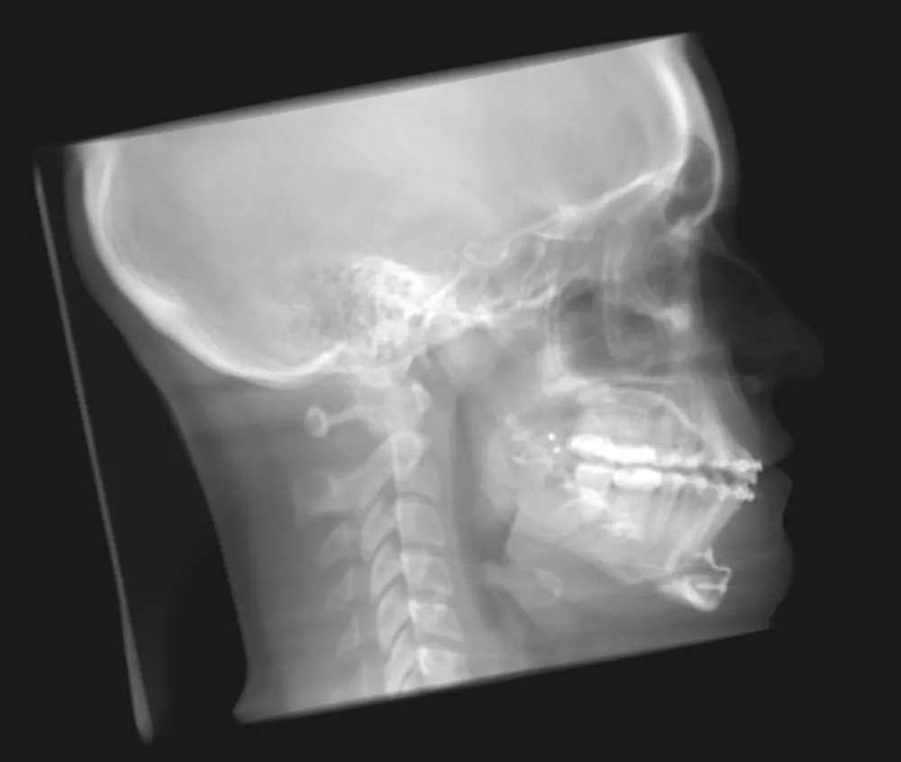 Post Op ceph procedure X ray