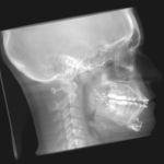Post Op ceph procedure X ray
