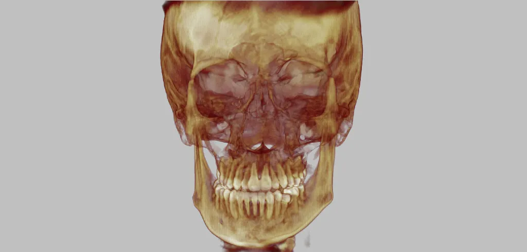 3D skull model in golden-brown tones, blue background, dental structures visible