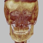 3D skull model in golden-brown tones, blue background, dental structures visible