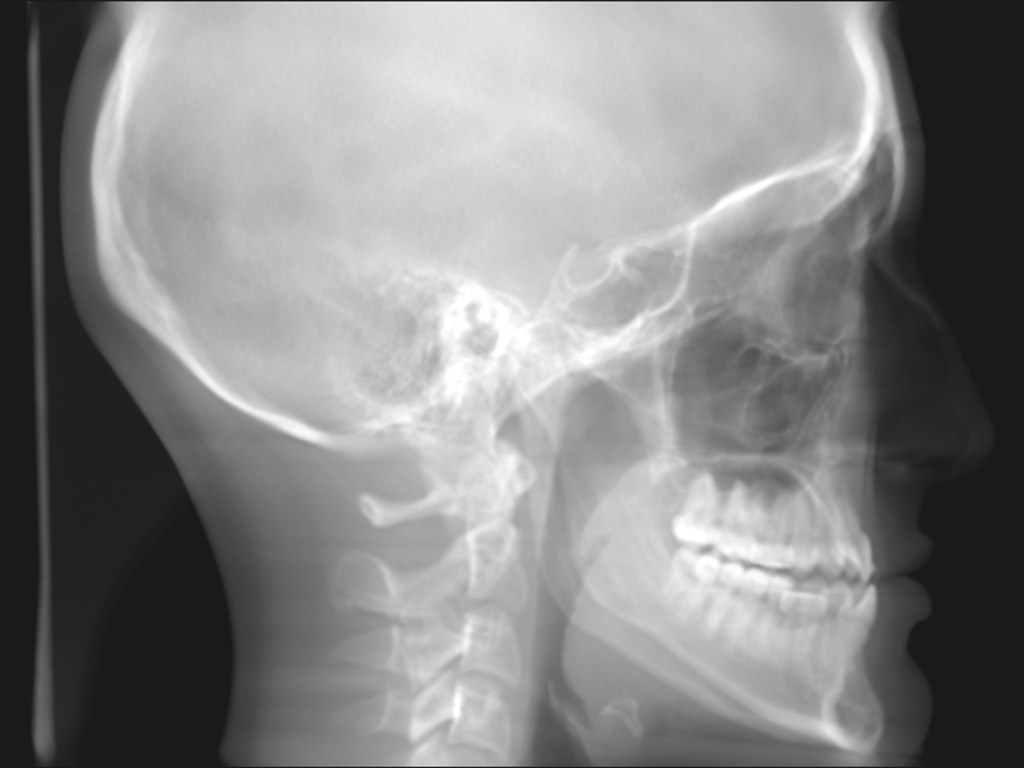 Lateral skull X-ray showing dental work, cervical spine, and intact maxillary sinus