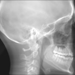 Lateral skull X-ray showing dental work, cervical spine, and intact maxillary sinus