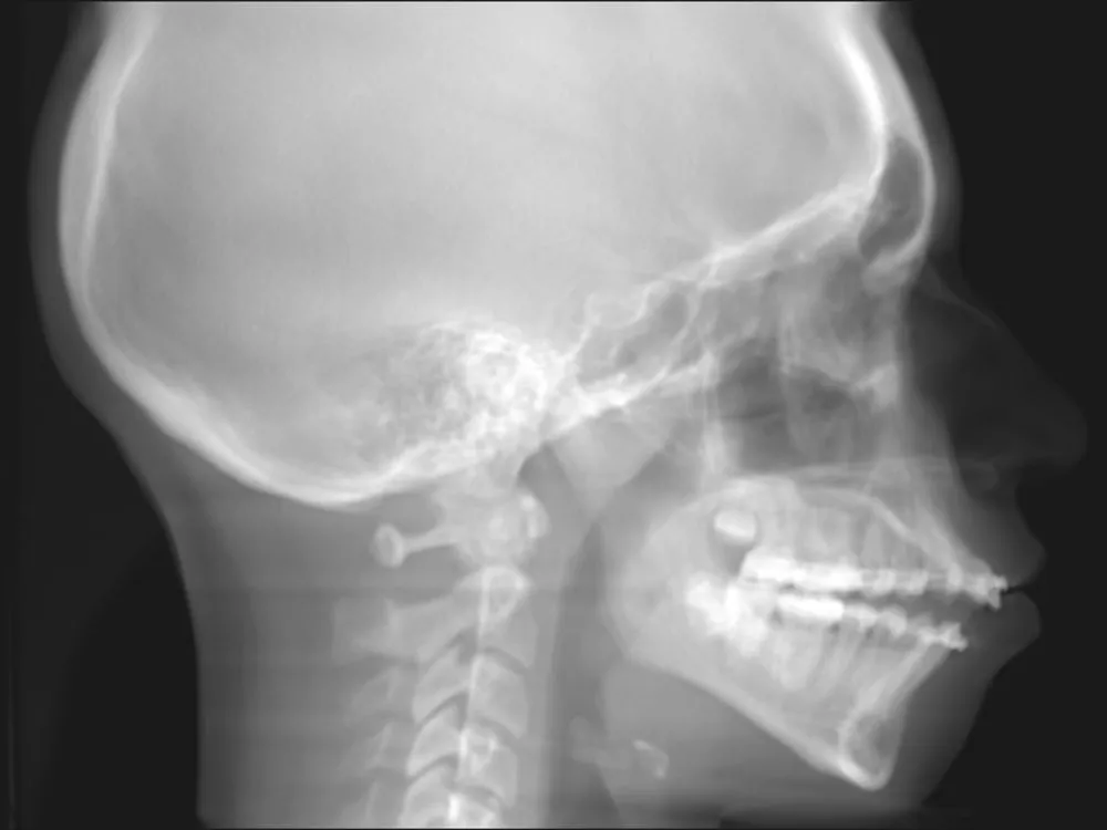 Pre Op ceph procedure X ray