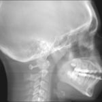 Pre Op ceph procedure X ray
