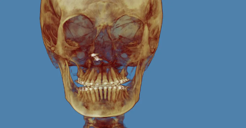 3D skull model: jaw highlighted in red, golden-brown tones, blue background