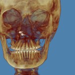 3D skull model: jaw highlighted in red, golden-brown tones, blue background