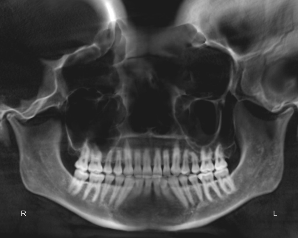 Panoramic dental X-ray showing full dentition and jaw