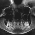 Panoramic dental X-ray showing full dentition and jaw
